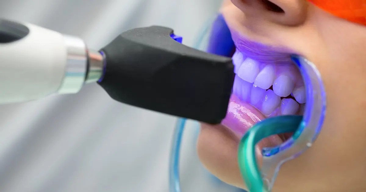 Blanqueamiento dental en Clínica Dali Dent Parla