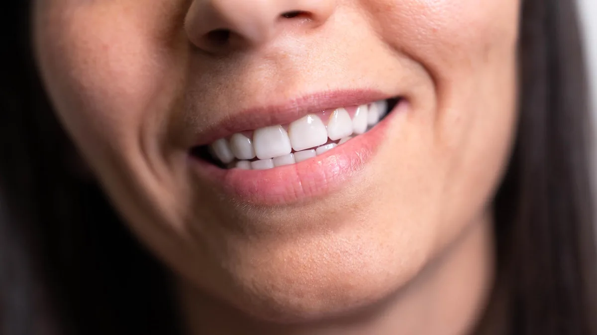Diseño de sonrisa en Parla